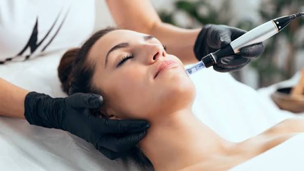 Microneedling en Mataró