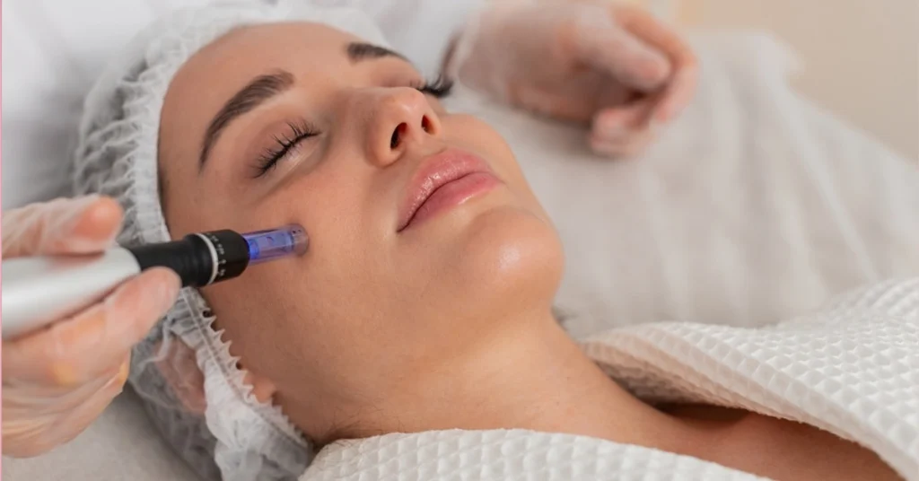 Microneedling en Mataró